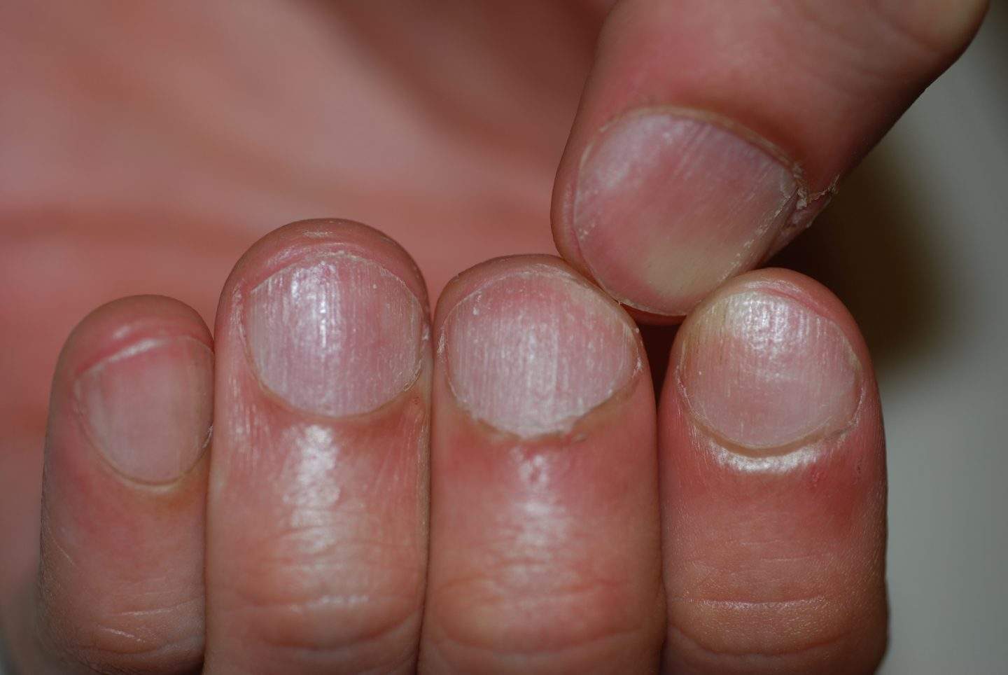 Alopecia areata delle unghie: trachionichia