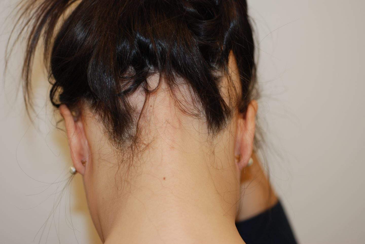 Nell'ofiasi l'alopecia areata colpisce esclusivamente i capelli dell'attaccatura