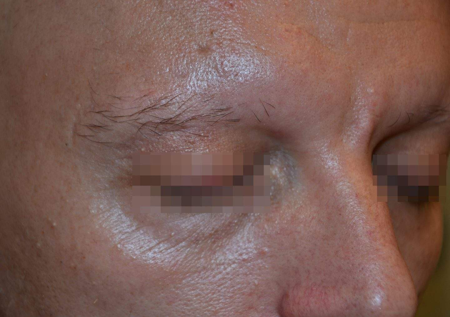 Alopecia areata parziale delle sopracciglia