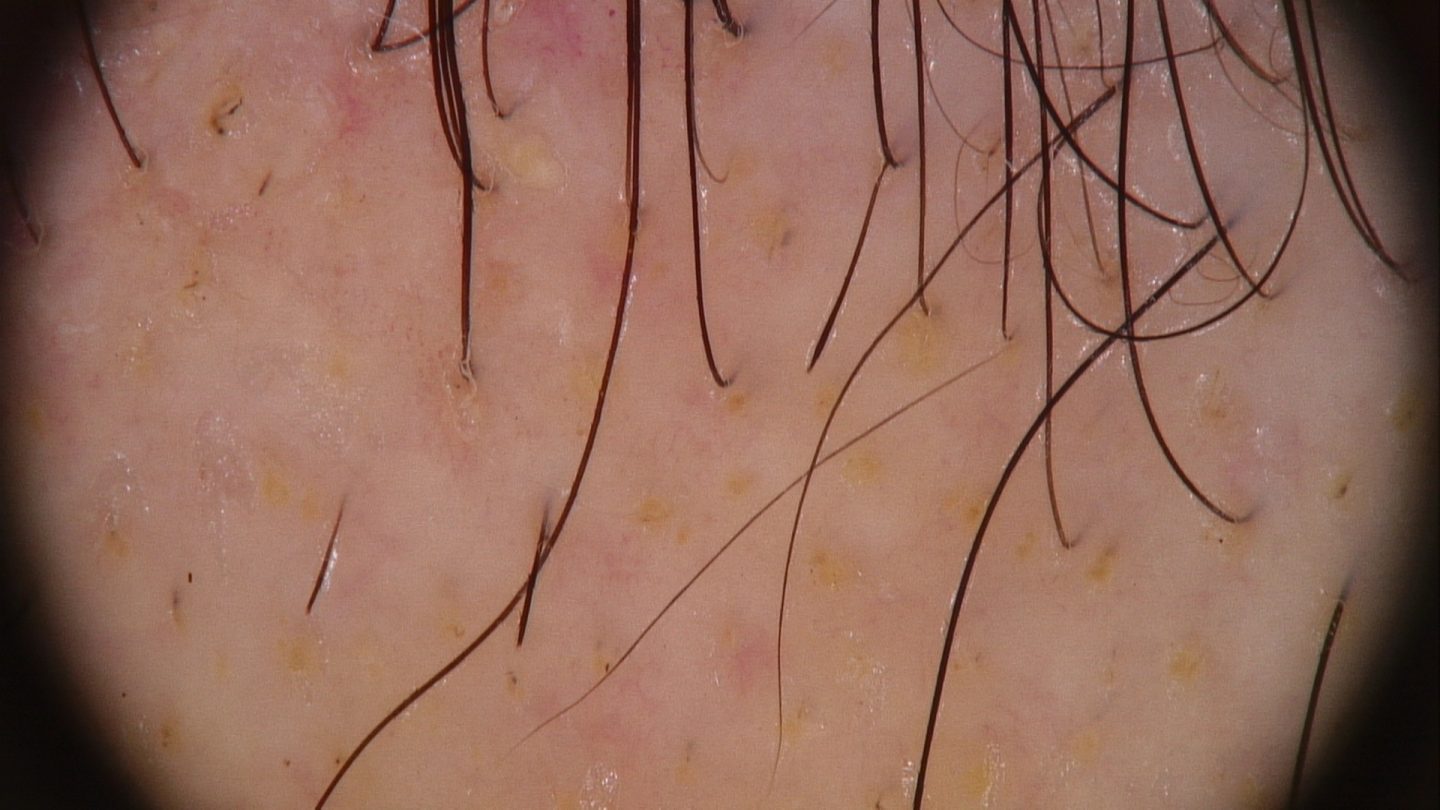 La tricoscopia permette di confermare la diagnosi di alopecia areata e di valutarne la fase di attività