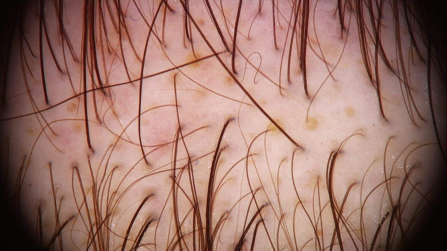 La dermoscopia nell'alopecia androgenetica
