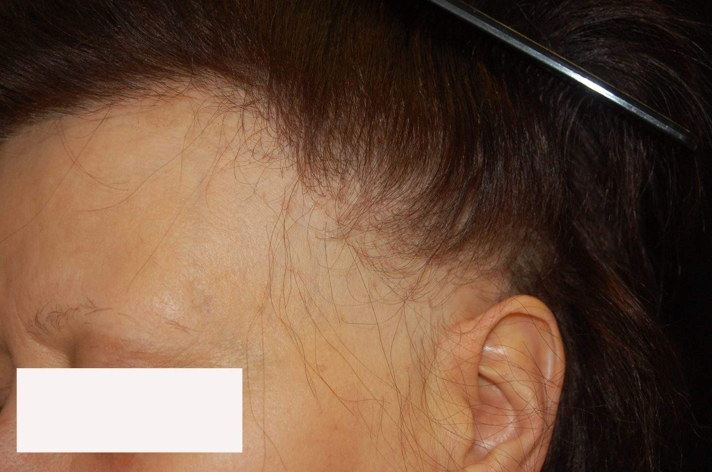 È frequente l'arretramento anche dell'attaccatura dei capelli dell'area periuaricolare