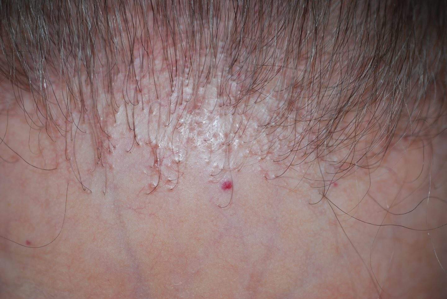 Nell'alopecia fibrosante frontale sono distrutti i peli intermedi e del vello presenti normalmente nell’attaccatura dei capelli