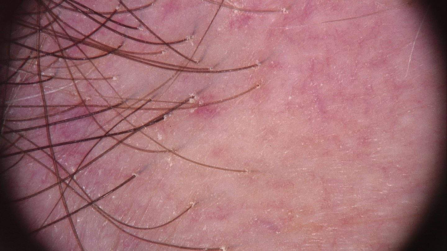 La tricoscopia mostra assenza di osti follicolari nella banda alopecica, e ipercheratosi follicolare con lieve eritema perifollicolare nei capelli residui