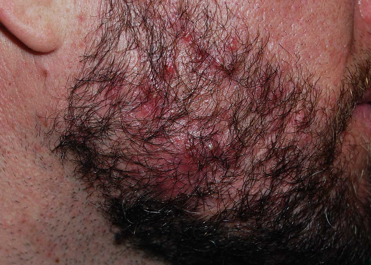 Altre malattie della barba: acne grave della barba