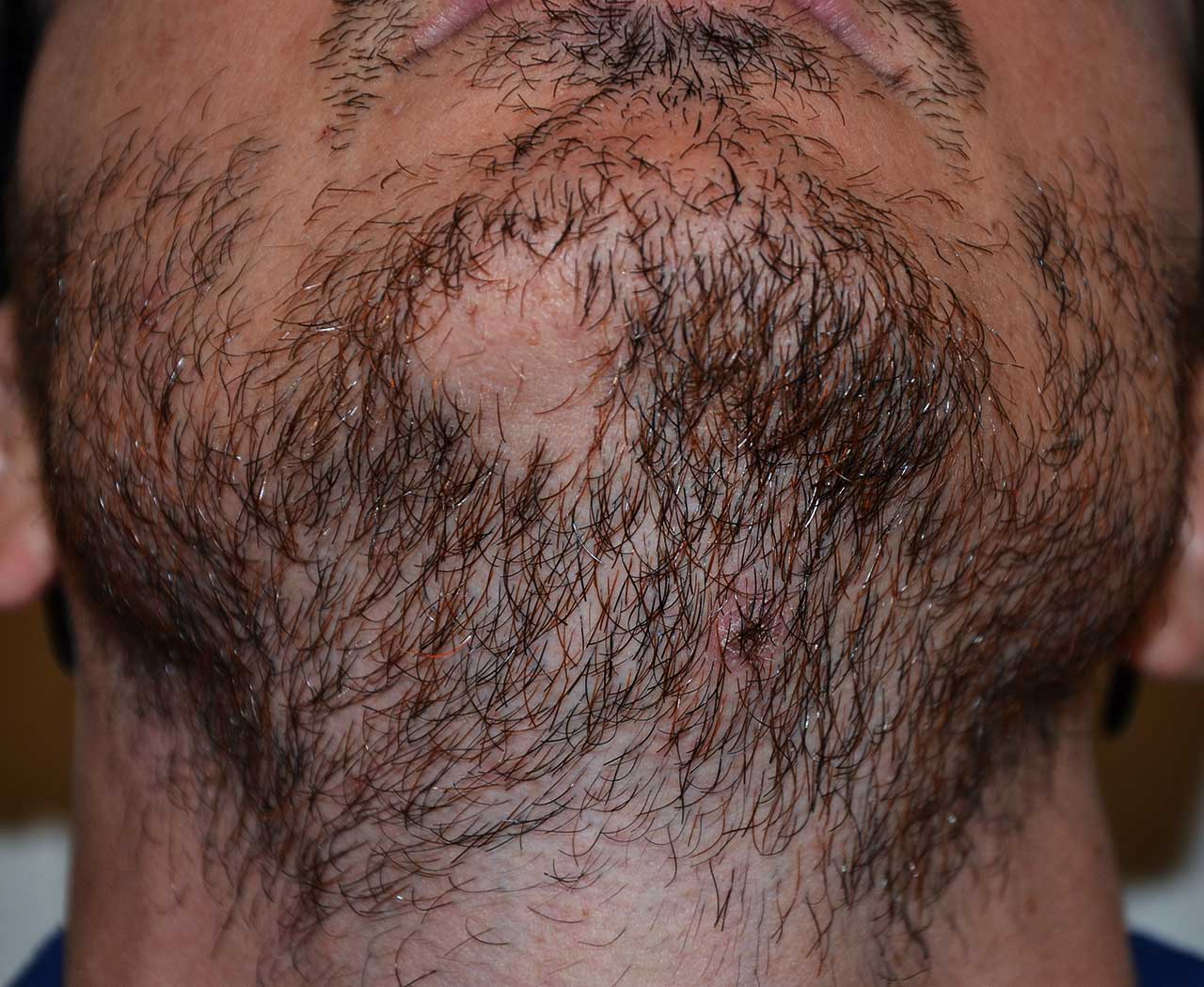 Alopecia areata della barba