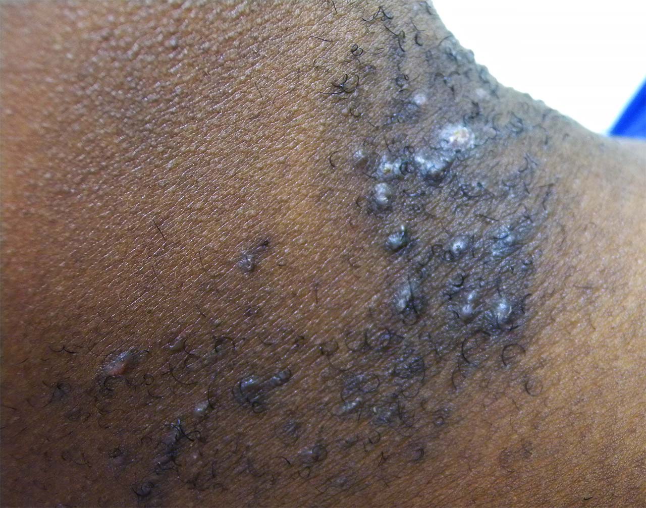 Follicoliti della barba: sono molto frequenti nella razza nera, dove i peli sono ricci