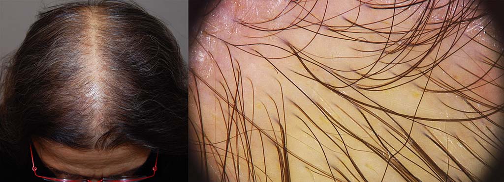 Alopecia diffusa