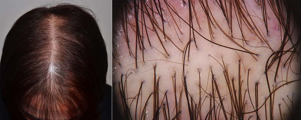 Alopecia androgenetica femminile: la "riga nel mezzo" è diventata più larga del normale, e la tricoscopia del vertice mostra l'assottigliamento di molti capelli