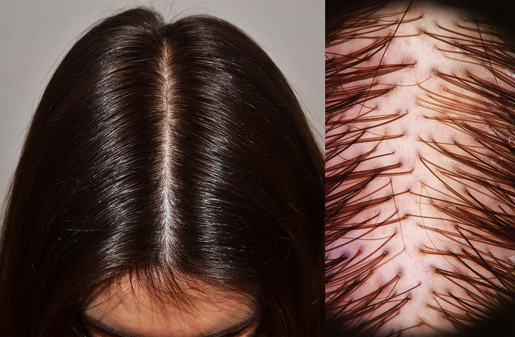 Telogen effluvium acuto: capelli spessi ma corti, in ricrescita, evidenti anche con la tricoscopia