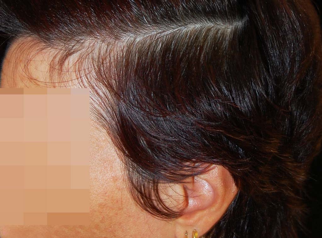 Telogen effluvium cronico: i capelli della regione temporale sono più corti e sottili
