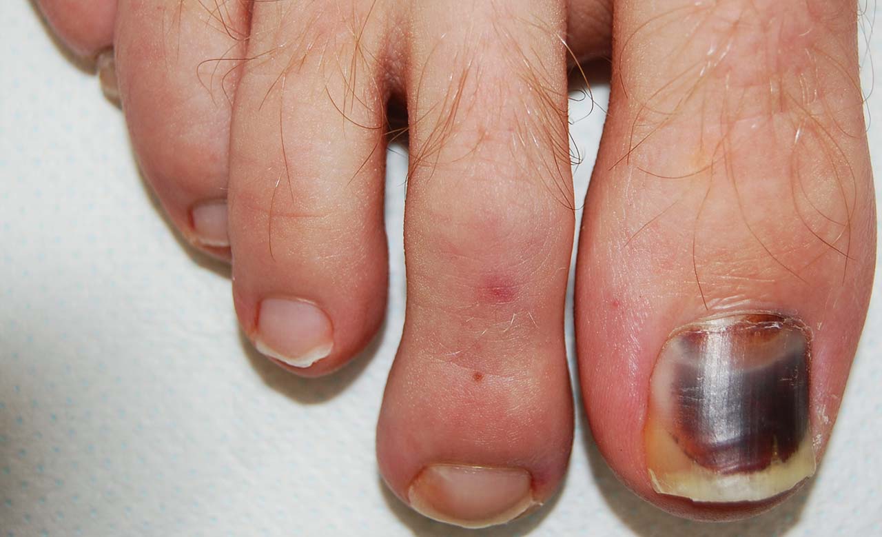 Ematoma subungueale acuto: colorazione rosso vino dell'unghia comparsa rapidamente dopo una partita di calcio, associata a intenso dolore