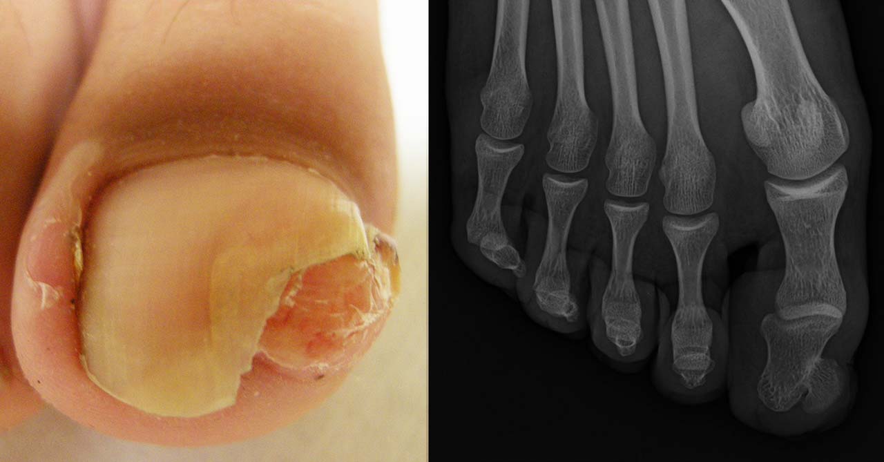 Esostosi subungueale: nodulo che solleva la parte laterale della lamina. La radiografia mostra la proliferazione ossea sottostante