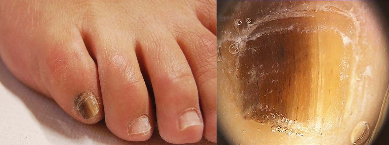 Melanonichia striata da frizione: l'unghia del 5° dito ha una banda longitudinale bruna, che alla dermoscopia appare come una banda marrone con strie brune e piccole emorragie puntiformi