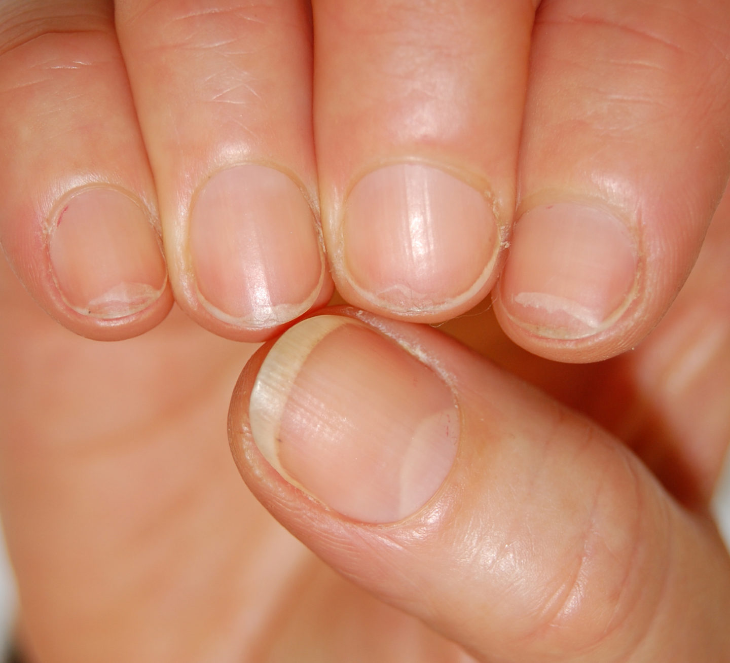 Fig. 1 Fragilità ungueale: nell’onicoschizia lamellina la parte finale dell’unghia si sfalda in senso orizzontale.