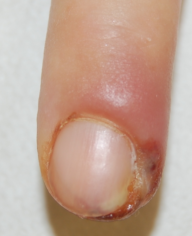 Fig. 15 Perionissi acuta con raccolta purulente laterale.