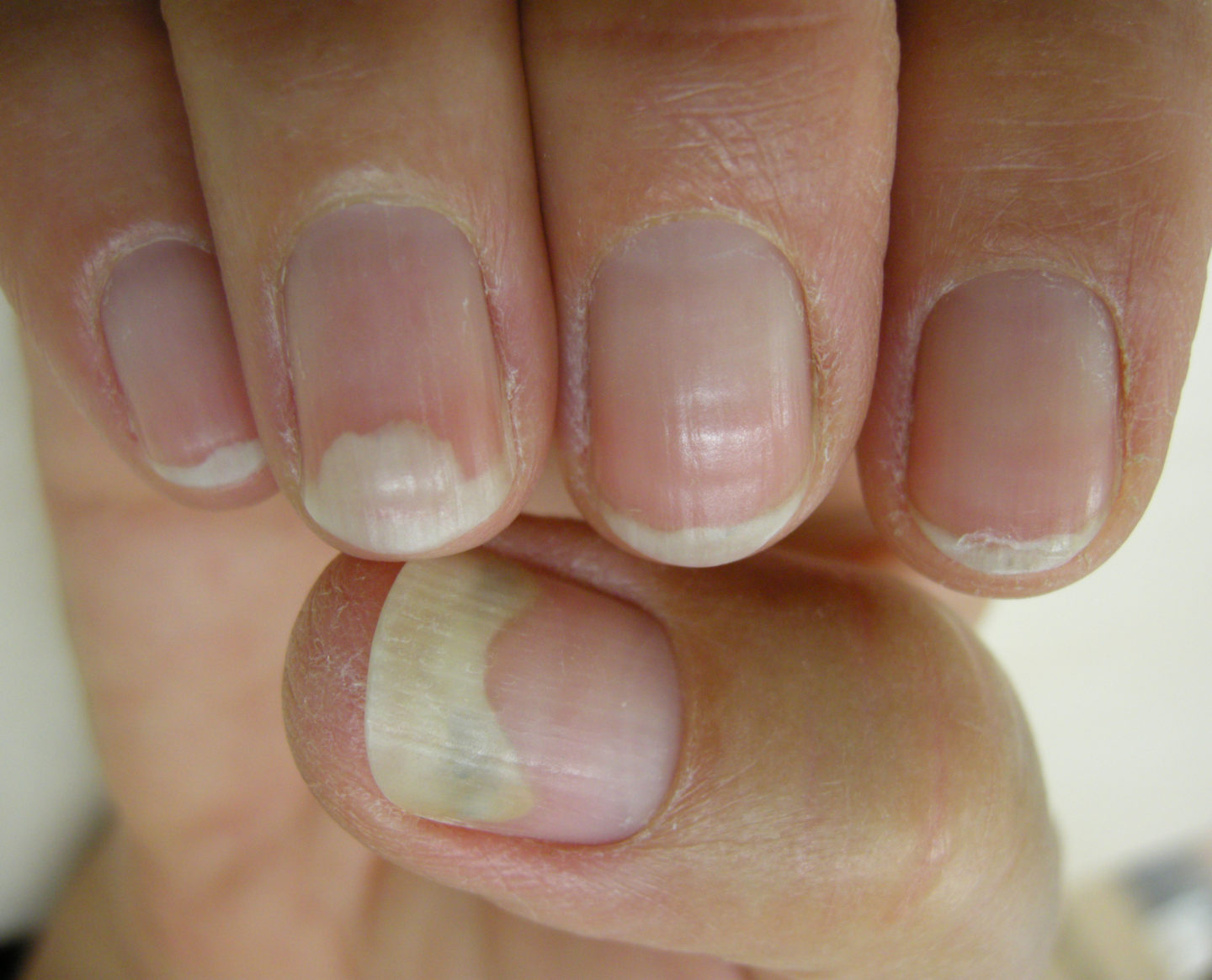 Fig. 4 Onicolisi delle mani: le unghie sono scollate e il colore è bianco per la presenza di aria