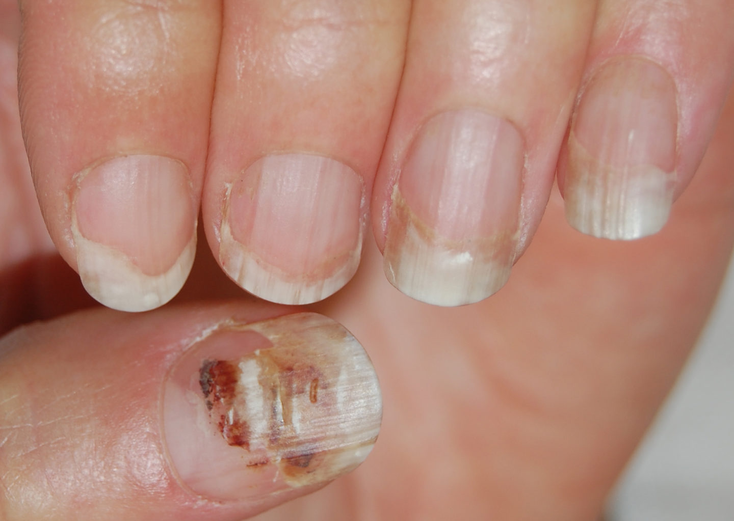 Fig. 5 Onicolisi delle mani: le unghie sono scollate e il colore è bianco per la presenza di aria. Il colore rosso dell’unghia del 1° dito è dovuto a un ematoma subunguale.