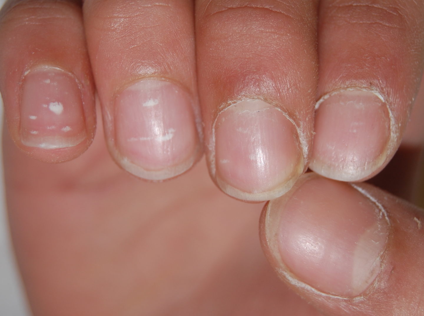 Fig. 8 Leuconichia puntata: tipica di più unghie delle mani dei bambini, sono macchie bianche che si spostano verso il margine libero dell’unghia con la crescita