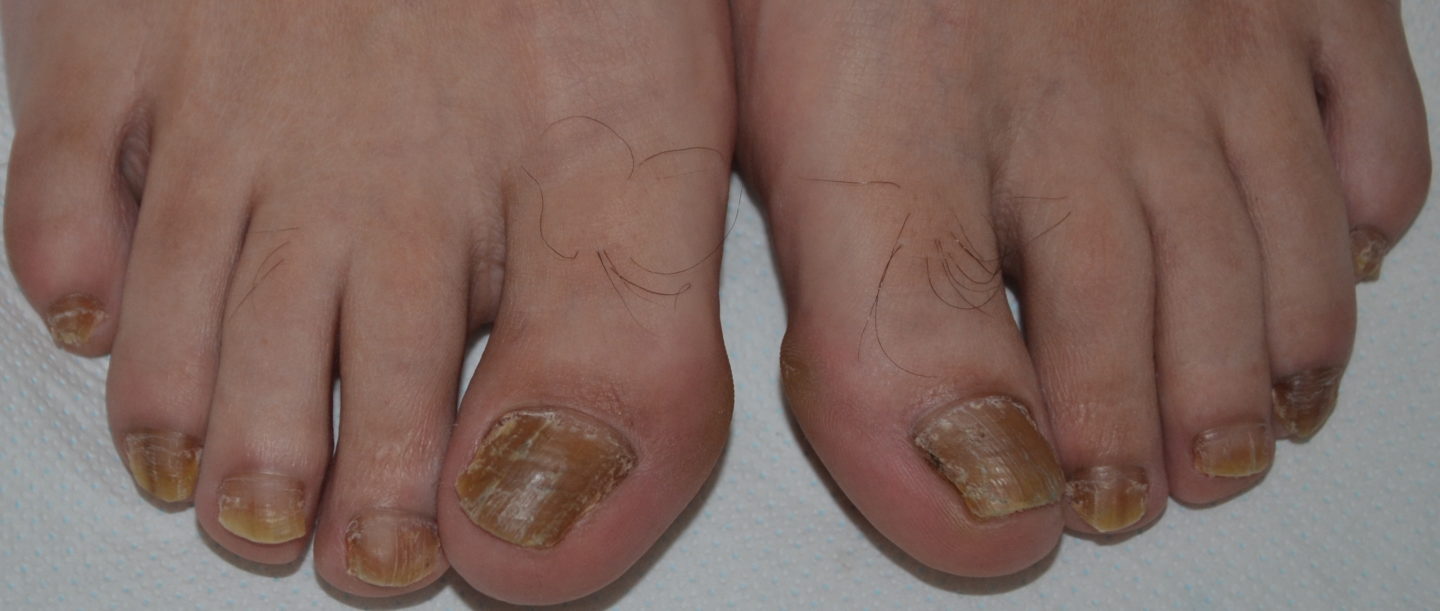 Psoriasi delle unghie dei piedi: le unghie sono diffusamente gialle e spesse.