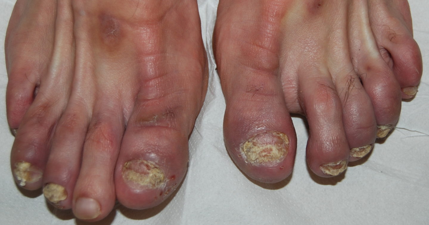 Psoriasi delle unghie dei piedi: le unghie giallastre e opache, con superficie friabile e edsquamante