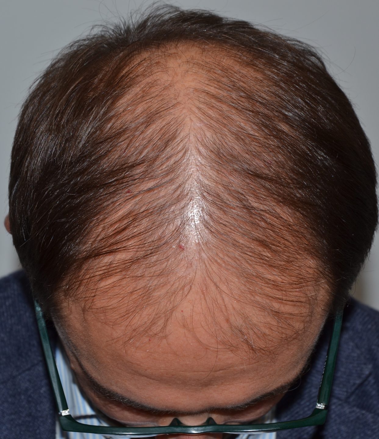 Alopecia androgenetica maschile di grado moderato: le aree diradate sono fuse insieme con alopecia diffusa del vertice e regione anteriore