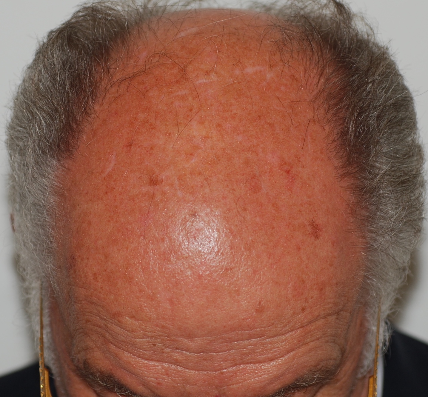 Alopecia androgenetica maschile grave: le aree colpite hanno solo peli e non più capelli.