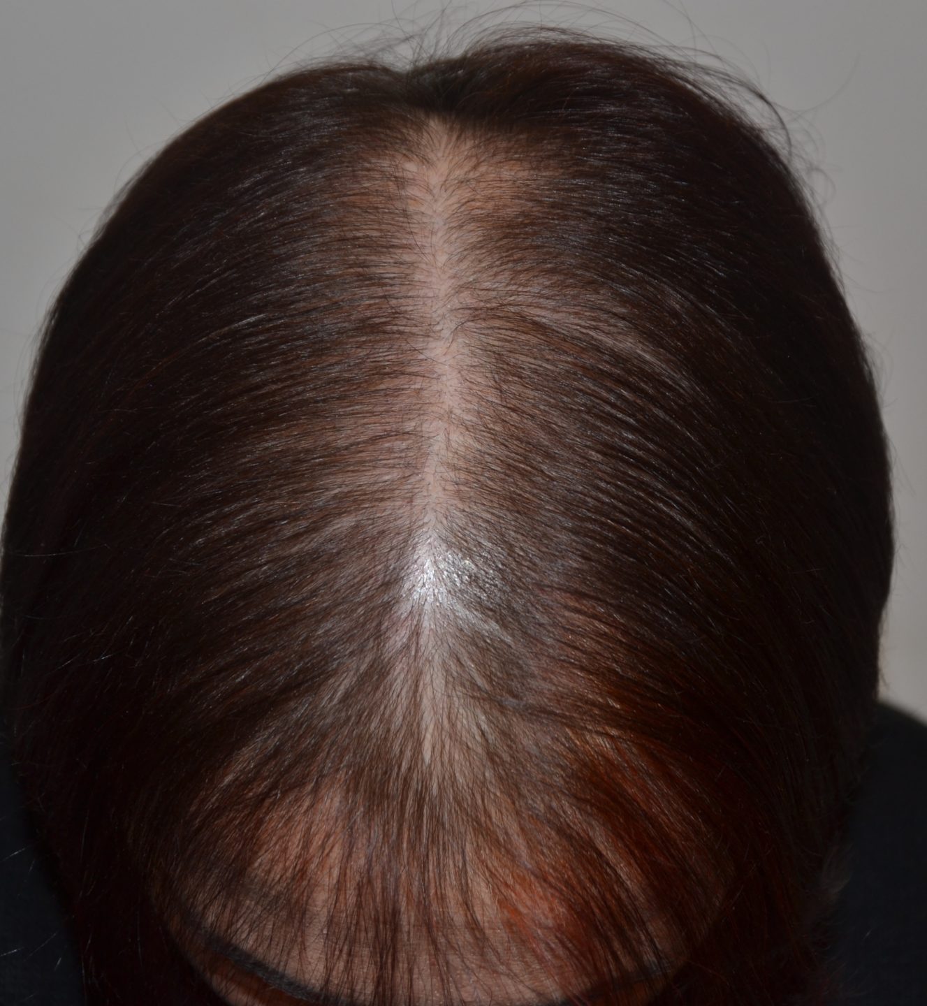 Alopecia androgenetica femminile: il diradamento dei capelli interessa la regione centrale del capo, senza arretramento dell’attaccatura dei capelli.