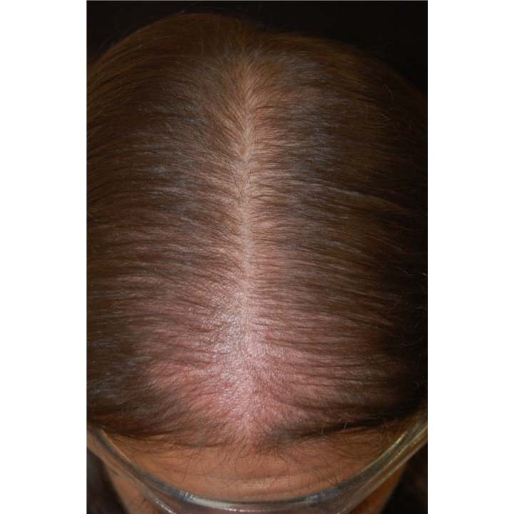Alopecia androgenetica femminile: aspetto “ad albero di Natale” del diradamento che è più grave nell’area anteriore del capo.
