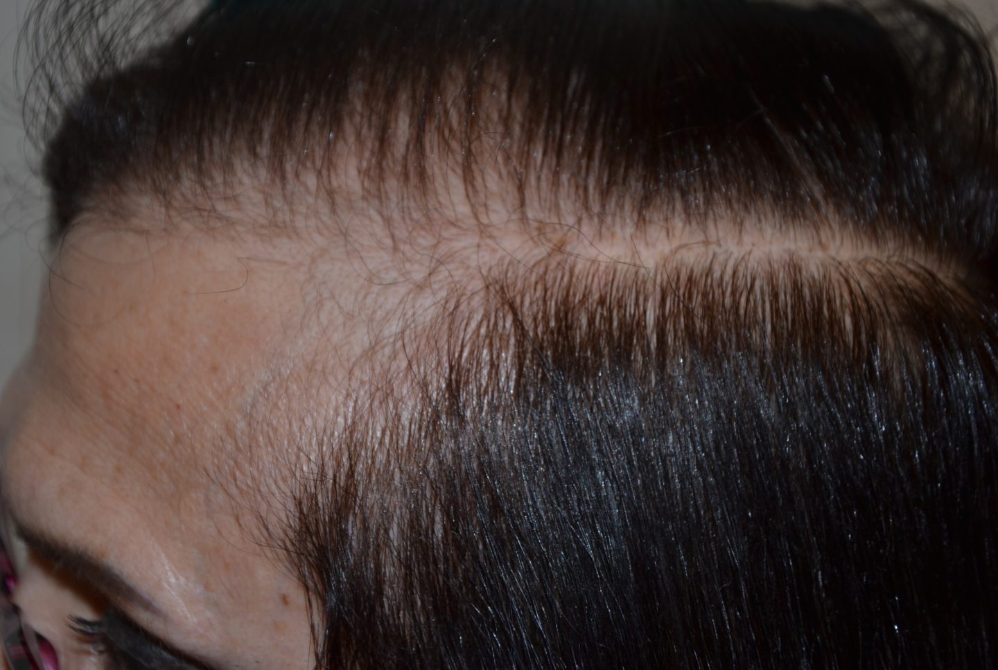 Retrocessione dell’attaccatura dei capelli alle tempie in una donna con alopecia androgenetica 