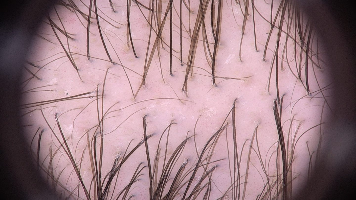 Tricoscopia dell’ alopecia androgenetica: variabilità del diametro dei capelli