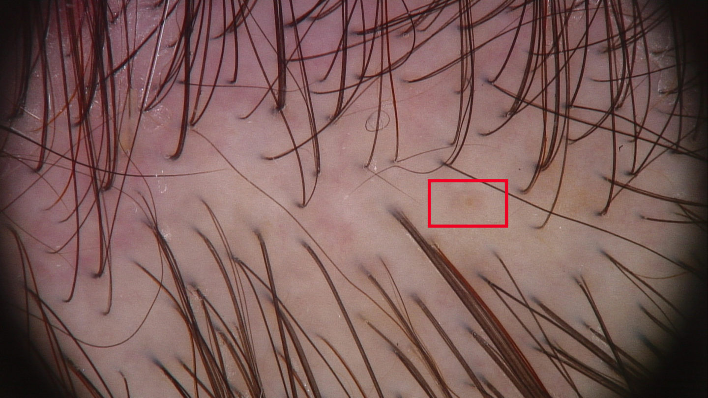 Tricoscopia dell’ alopecia androgenetica: otre alla variabilità del diametro dei capelli è ben visibile un follicolo vuoto.