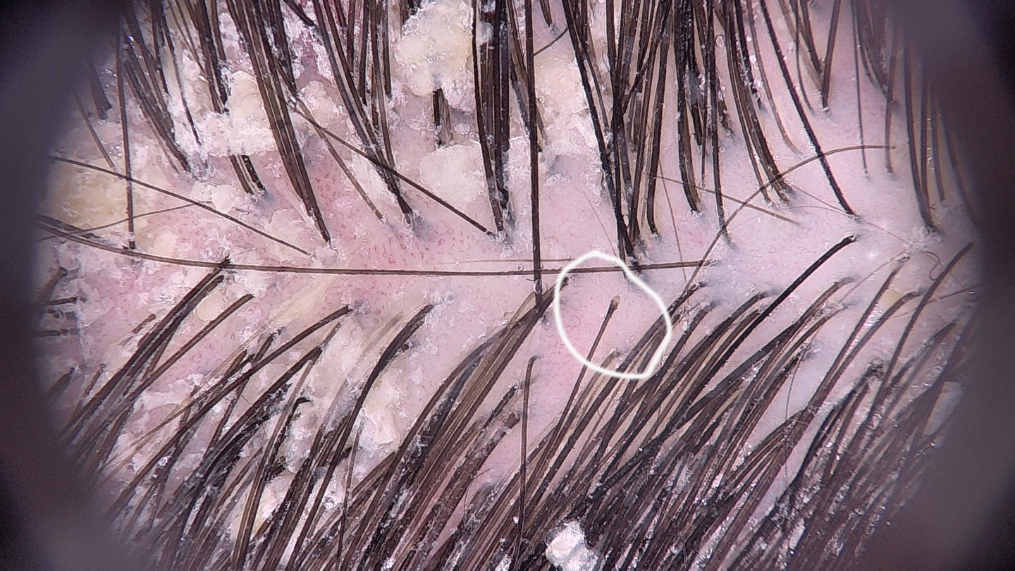 Fig. 2 La forfora e la dermatite seborroica peggiorano tipicamente in autunno e si associano a aumentata caduta dei capelli: la foto della tricoscopia mostra squame e arrossamento del capo e nel cerchio bianco un capello telogen che sta cadendo.