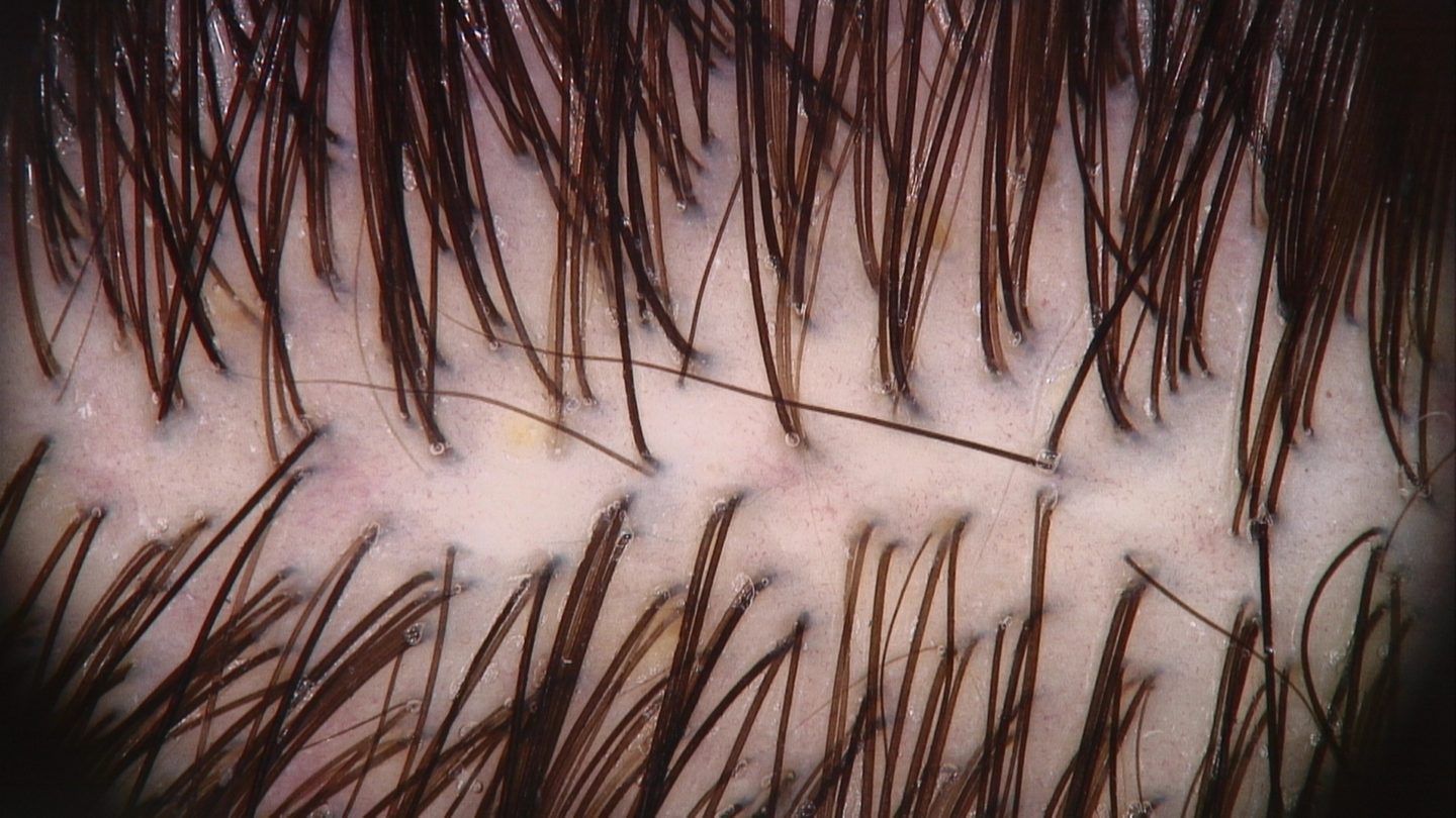 Fig. 3 La tricoscopia del telogen effluvium acuto mostra un normale diametro e un numero normale dei capelli e la presenza diffusa di piccoli capelli corti in ricrescita (a forma conica).