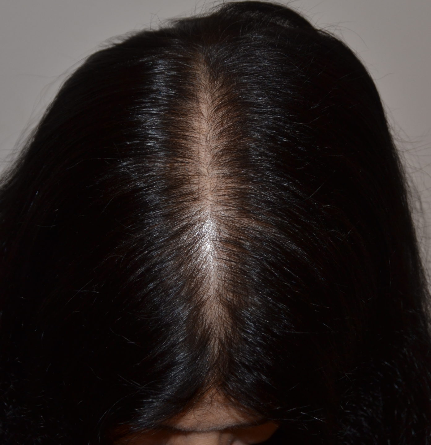 Fig. 4 Questa donna di 32 anni lamenta un aumento della caduta dei capelli in settembre. L’osservazione clinica mostra una riga nel mezzo leggermente più larga del normale (a). Il pull test è positivo al vertice, la tricoscopia (b) mostra che molti capelli hanno un diametro variabile da sottile al normale.