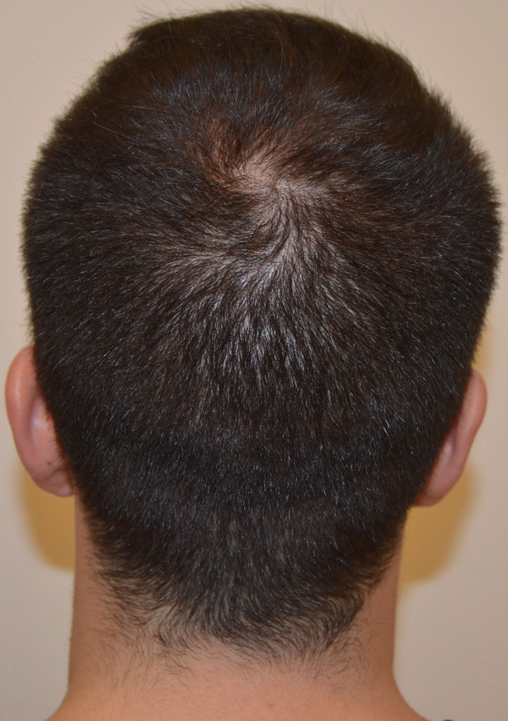 Fig. 4 Questa ragazzo di 25 anni si è accorto in autunno di perdere più capelli del solito. Al vertice è visibile un lieve diradamento dei capelli (a) e il pull test è positivo. La tricoscopia (b) mostra che molti hanno un diametro sono più corti e sottili del normale.
