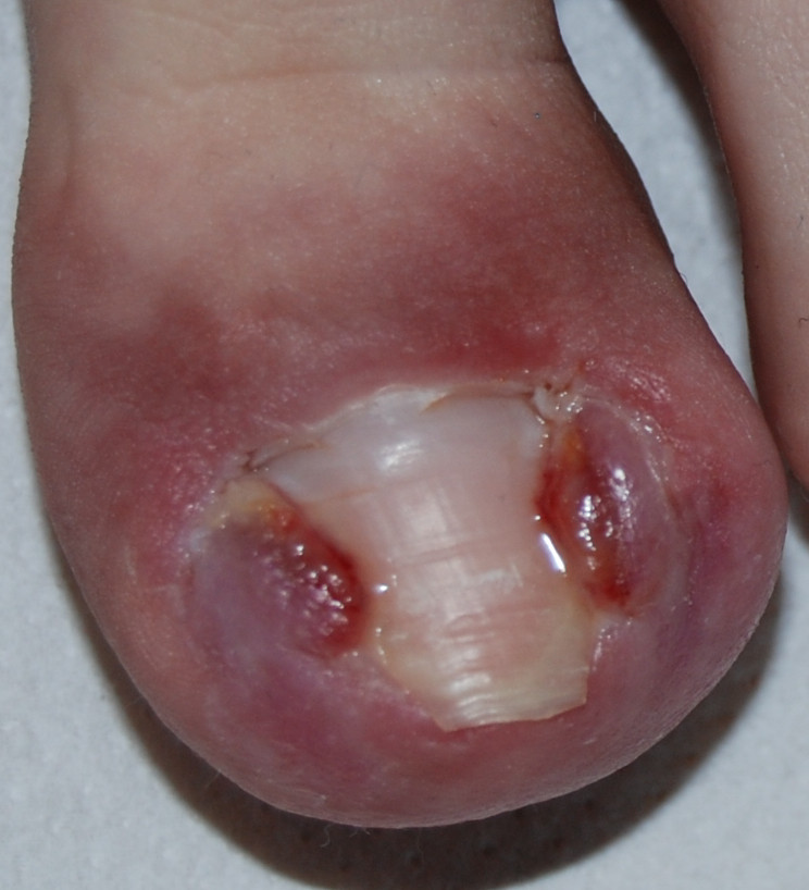 Fig. 10 Unghia incarnita di II grado: il granuloma piogenico e l’infiammazione peggiorano progressivamente se non è effettuata alcuna cura.