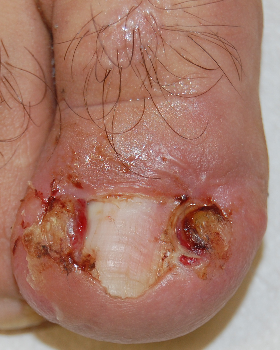 Fig. 11 Unghia incarnita di II grado: il granuloma piogenico e l’infiammazione peggiorano progressivamente se non è effettuata alcuna cura.