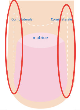 Fig. 16 Con l’intervento di fenolizzazione si distruggono in modo selettivo i corni laterali della matrice portando a un restringimento dell’unghia.