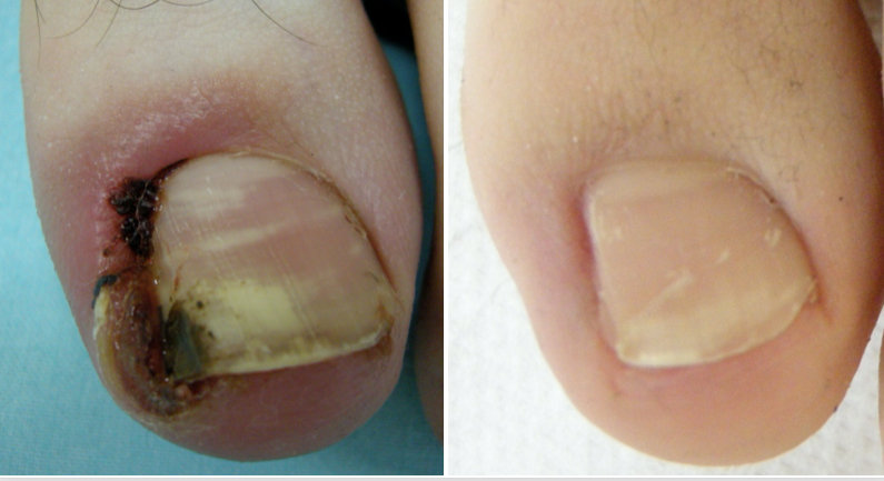 Fig. 17 Unghia incarnita di II grado pre e post intervento di fenolizzazione del corno laterale della matrice. Dopo 2 mesi dall’intervento sono scomparsi tutti i segni infiammatori con ottimo aspetto dell’unghia.