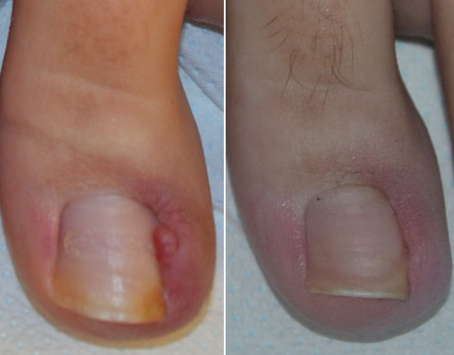 Fig. 18 Unghia incarnita di II grado pre e post intervento di fenolizzazione del corno laterale della matrice. Dopo 1 mese dall’intervento sono scomparsi tutti i segni infiammatori con ottimo aspetto dell’unghia.