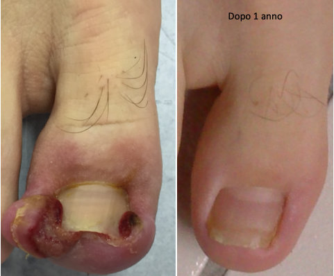 Fig. 19 Unghia incarnita di II- III grado pre e post intervento di fenolizzazione dei corni laterali della matrice. Al controllo dopo 1 anno dall’intervento si osserva la persistenza della guarigione.