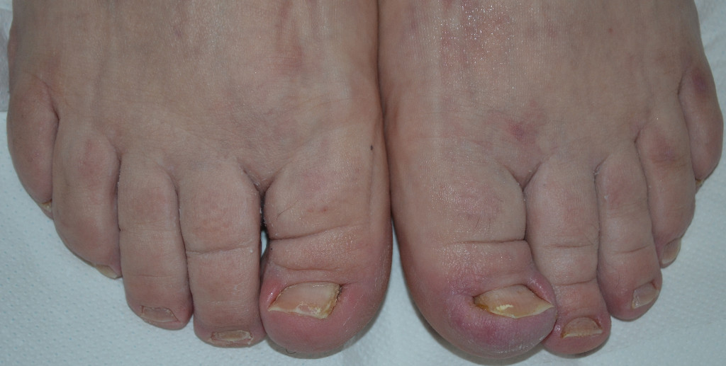 Fig. 1 Malallineamento congenito delle unghie degli alluci con iniziale incarnimento laterale.