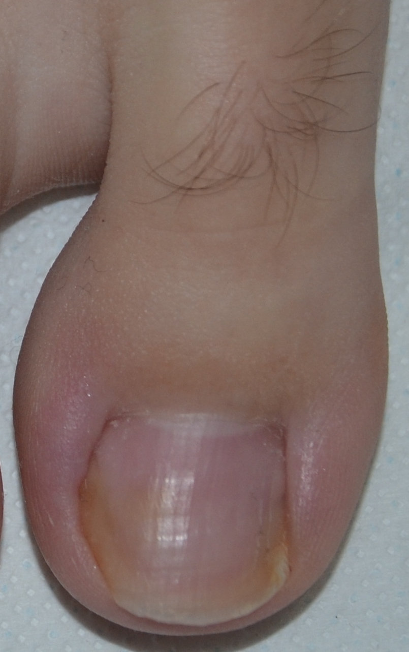 Fig. 5 Il taglio delle unghie dei piedi non dare al margine libero dell’unghia una forma rotonda, ma deve lasciare gli angoli dell’unghia fuori dal bordo distale.