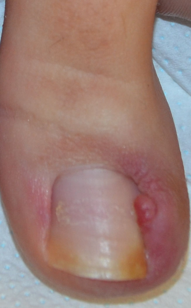 Fig. 8 Unghia incarnita di II grado: dalla piega ungueale emerge un granuloma sanguinante e doloroso.