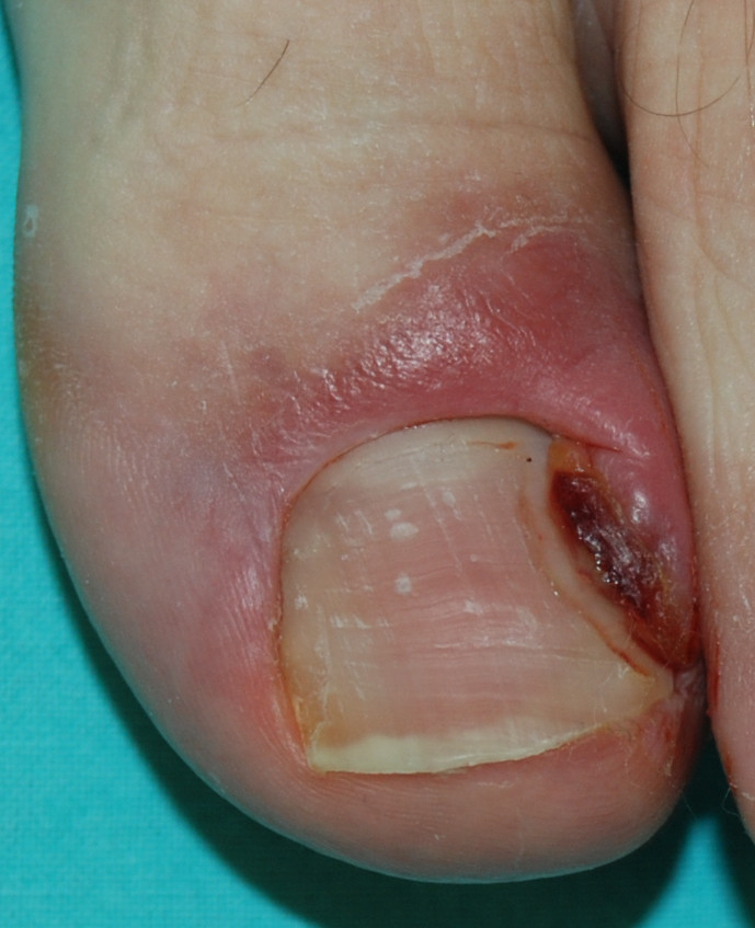 Fig. 9 Unghia incarnita di II grado: il granuloma piogenico e l’infiammazione peggiorano progressivamente se non è effettuata alcuna cura.