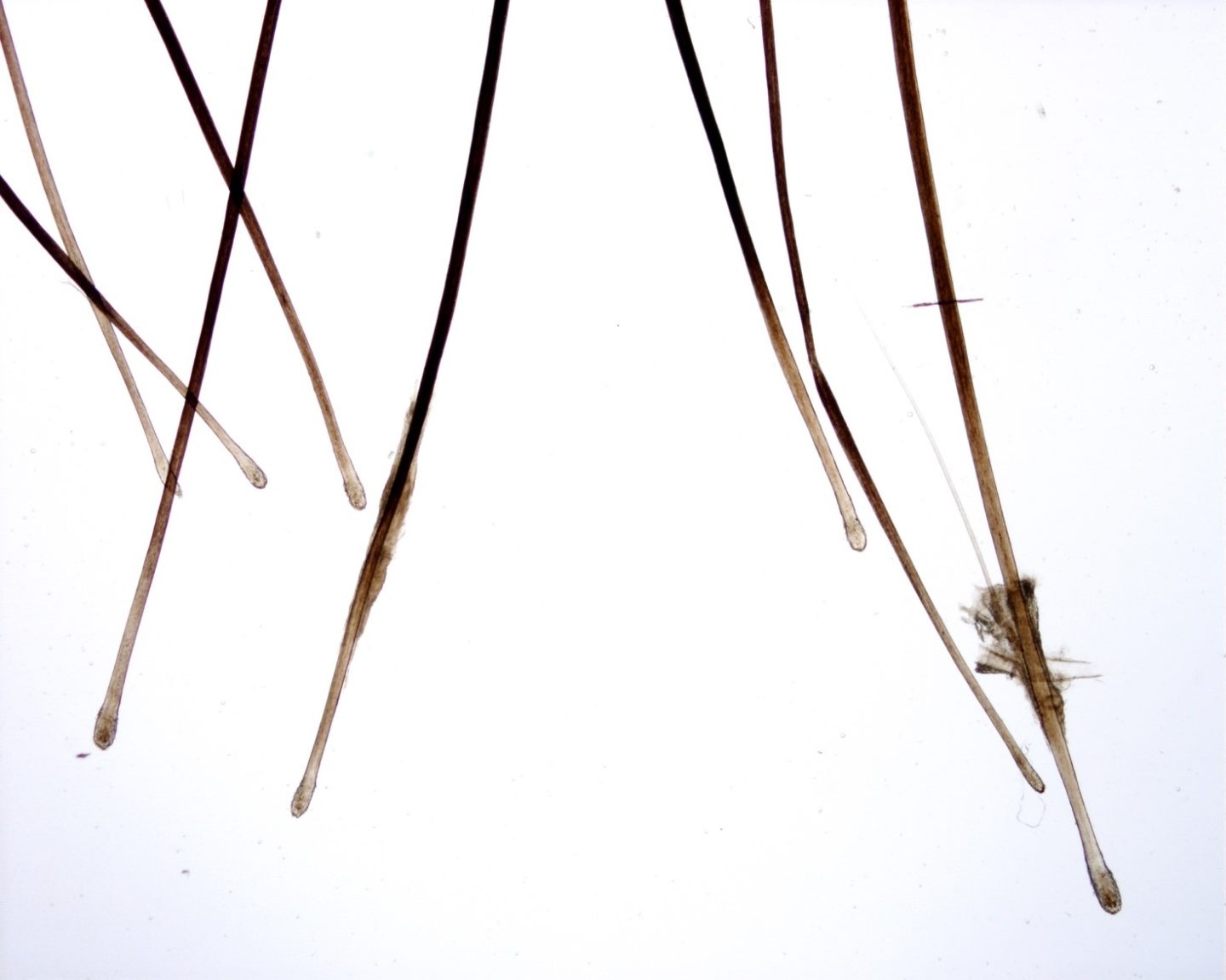 Fig.1: Radici telogen dei capelli persi dopo infezione da virus SARS-CoV-2
