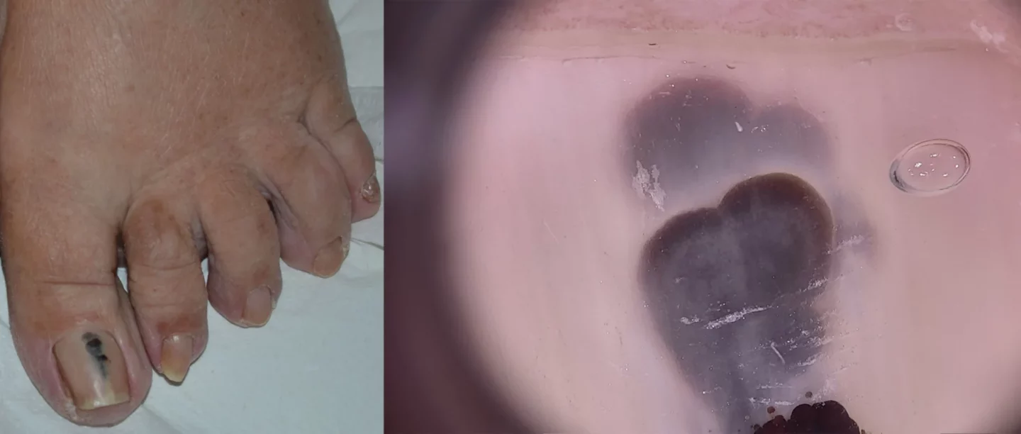 Fig. 1 L’ematoma subungueale può causare una macchia nera dell’unghia. L’osservazione con dermatoscopio mostra il colore rosso porpora del sangue depositato sotto l’unghia, e la forma rotonda dell’emorragia.