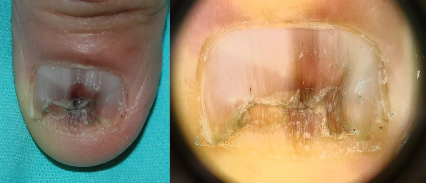 Fig.11 Melanoma dell’unghia in un uomo di 54 anni. Banda di melanonichia longitudinale di colore irregolare che coinvolge più di metà dell'unghia, associata a assottigliamento e fissurazioni della lamina. 