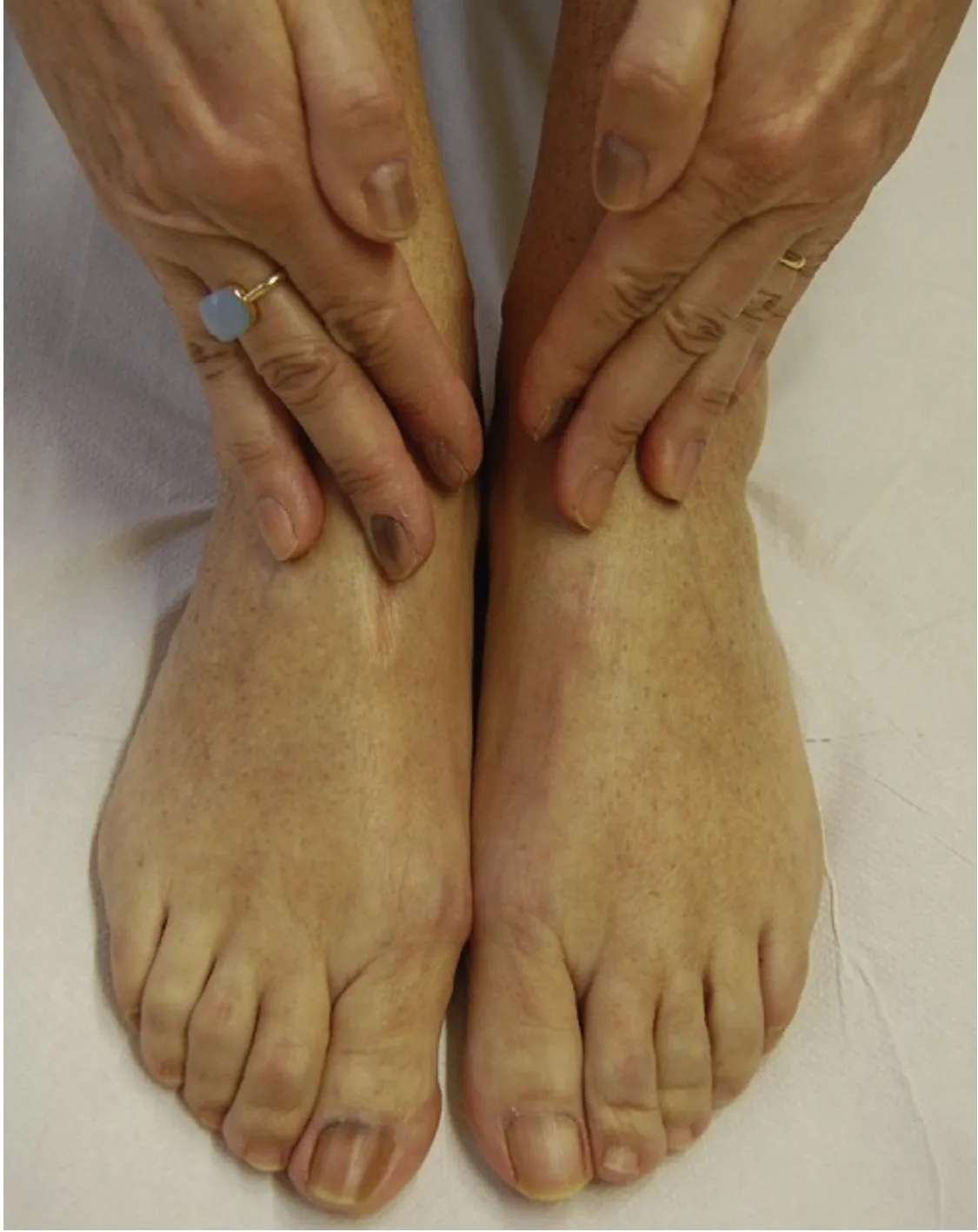 Fig. 2 Melanonichia di diverse unghie in una paziente in chemioterapia con ciclofosfamide.